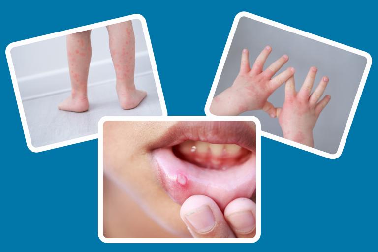 A collage of three images showing a childs legs with a rash, a childs hands with a rash, and a childs mouth with a cold sore.
