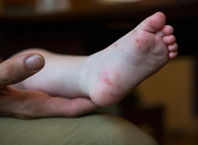 An adult is holding a babys foot with red spots.