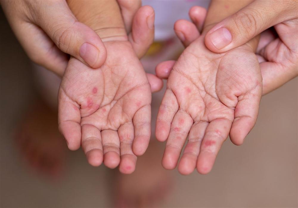 A close-up image of a childs hands with a rash on them.
