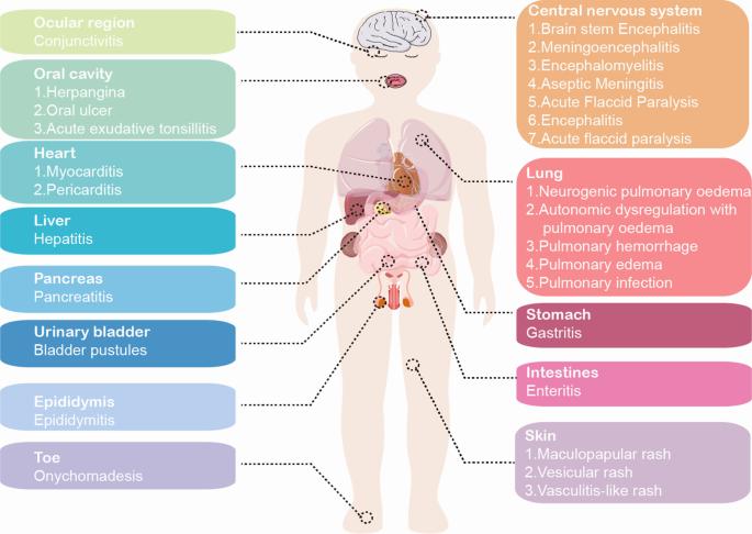 An illustration showing the organs affected by enterovirus D68.