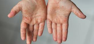 The image shows a persons hands with red, irritated skin.
