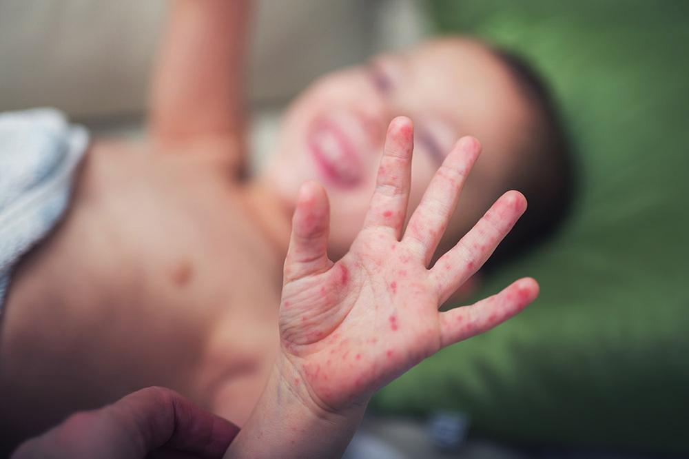 A child with a rash on their hand.