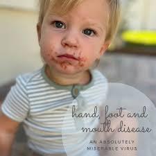 A young child with hand, foot and mouth disease has a rash on their face.