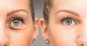 The image shows a comparison of a womans eye with dark circles under it and the same eye with no dark circles.