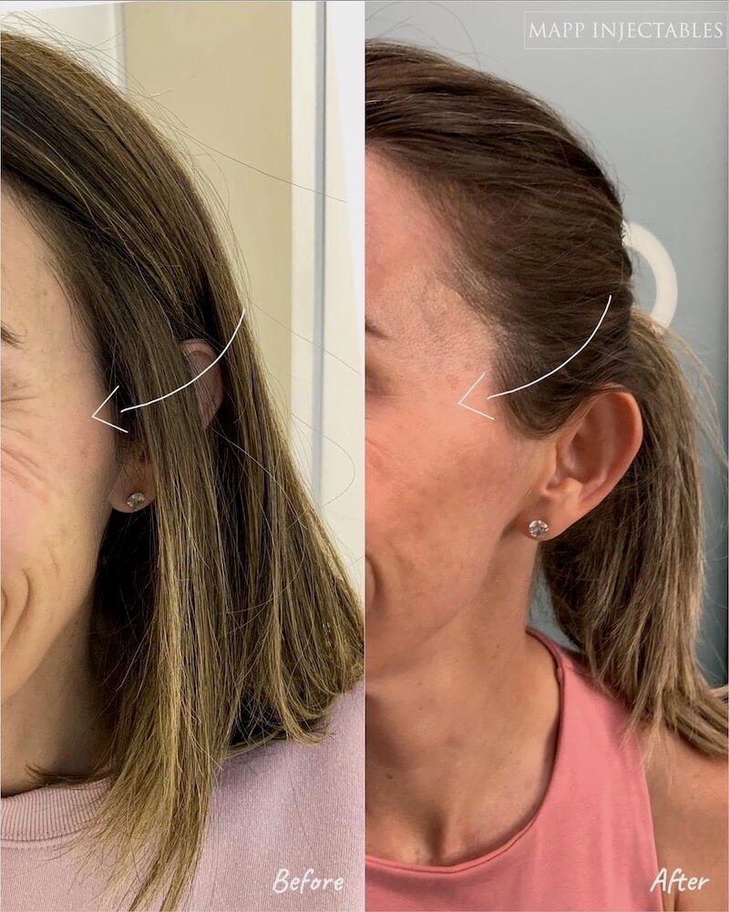 The image shows a womans face before and after a cosmetic procedure, with arrows pointing at the treated areas.