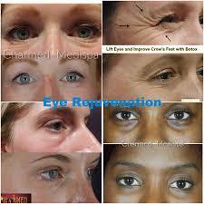 Before and after images of eye rejuvenation procedures.