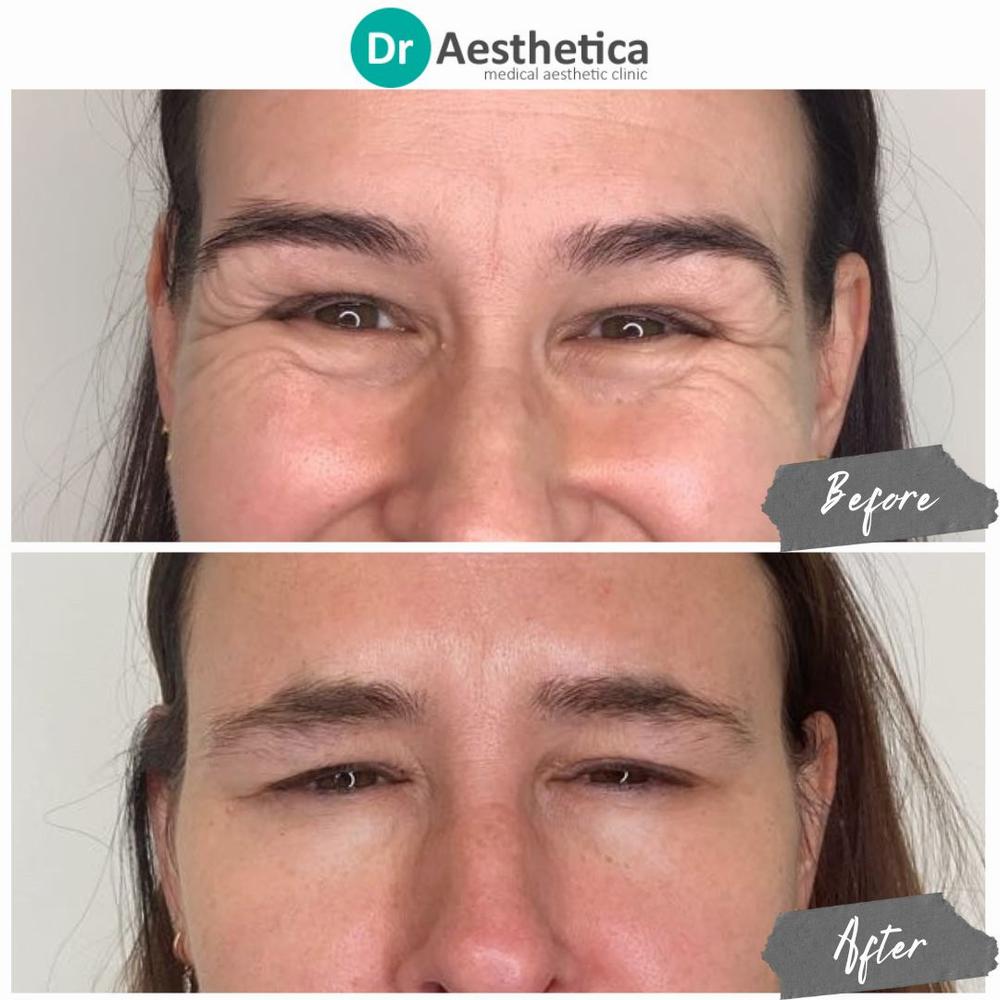 The image shows a womans face before and after crows feet treatment.