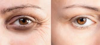 The image shows a before and after comparison of a womans eye with wrinkles and dark circles.