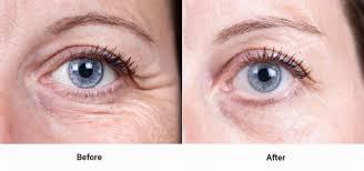 A womans eye with crows feet before and after anti-wrinkle treatment.
