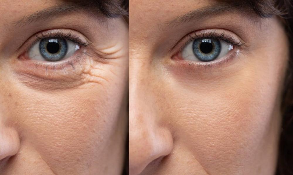 The image shows a before and after comparison of a womans face with wrinkles around her eyes.