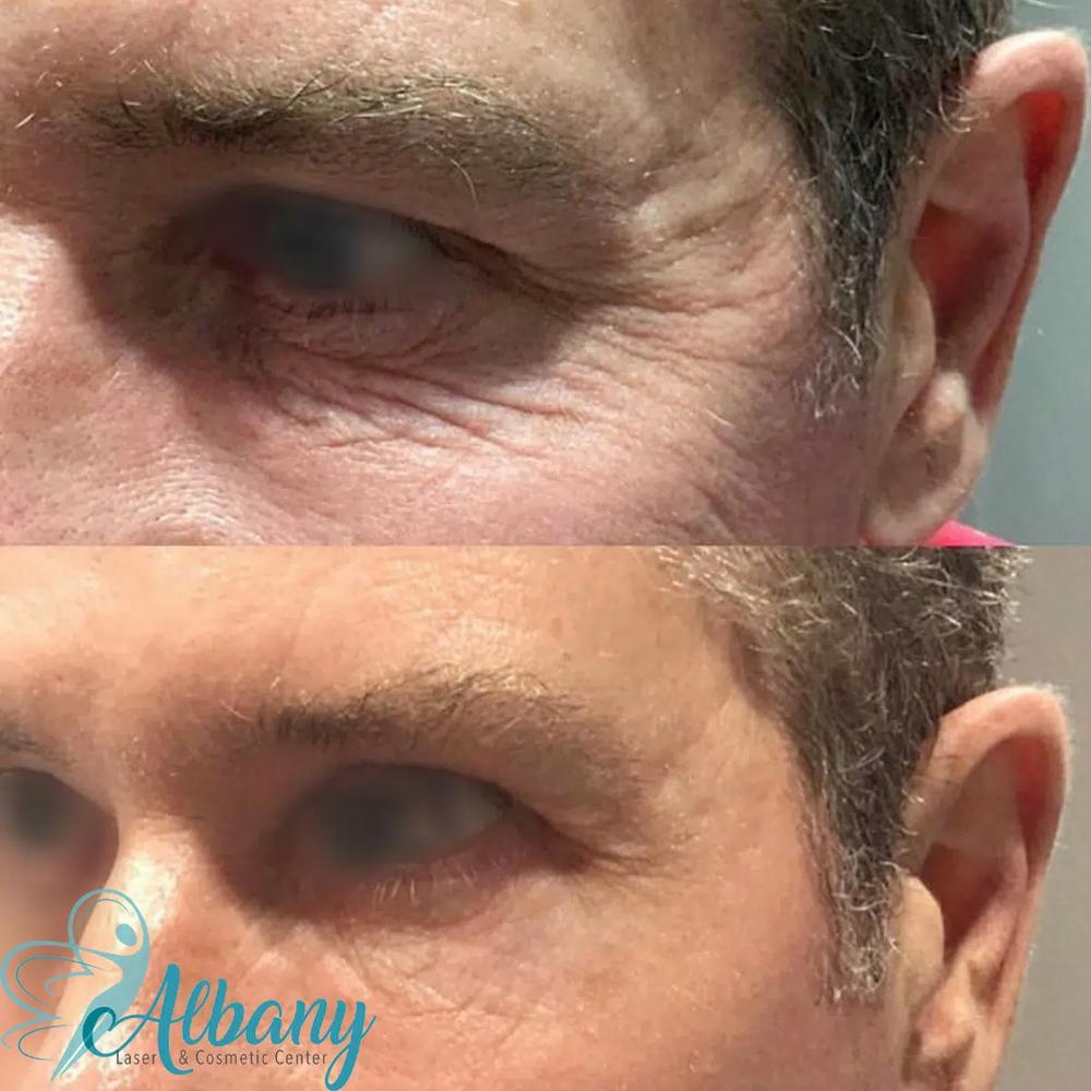 Albany Laser & Cosmetic Center offers a variety of treatments to help you look and feel your best, such as this clients crows feet treatment.