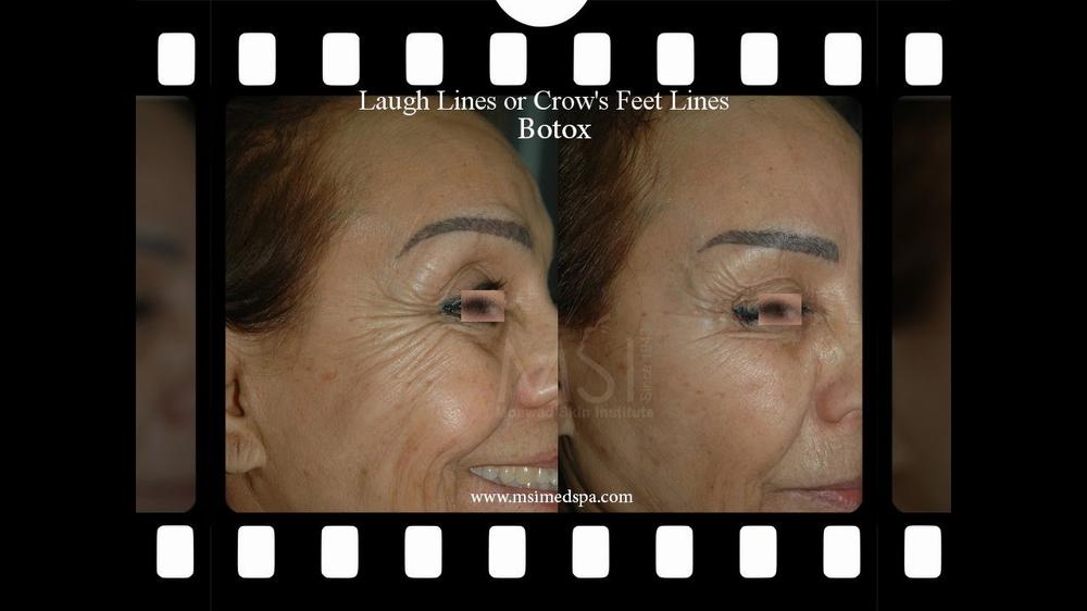 The image shows a before-and-after comparison of a womans face after receiving Botox injections to treat laugh lines and crows feet.