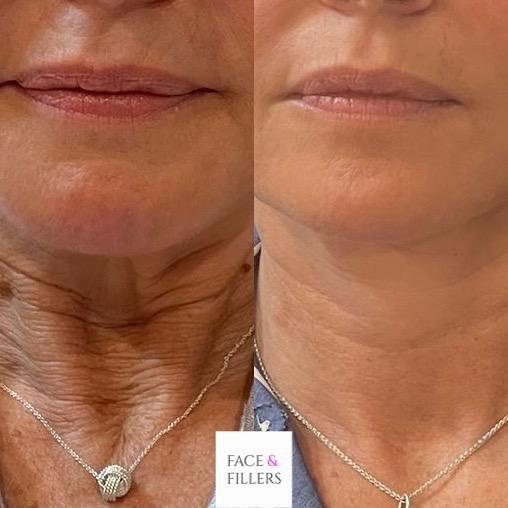 The image shows a before and after comparison of a woman who had a neck lift.