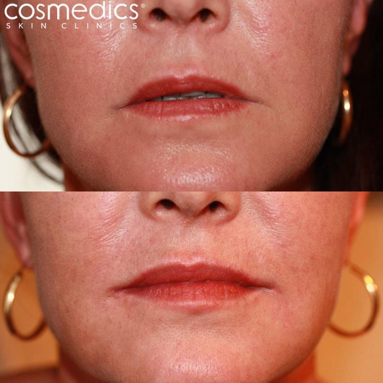 The image shows a before and after comparison of a womans lips after having lip augmentation.