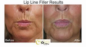 The image shows a before and after comparison of a woman who had lip line filler.