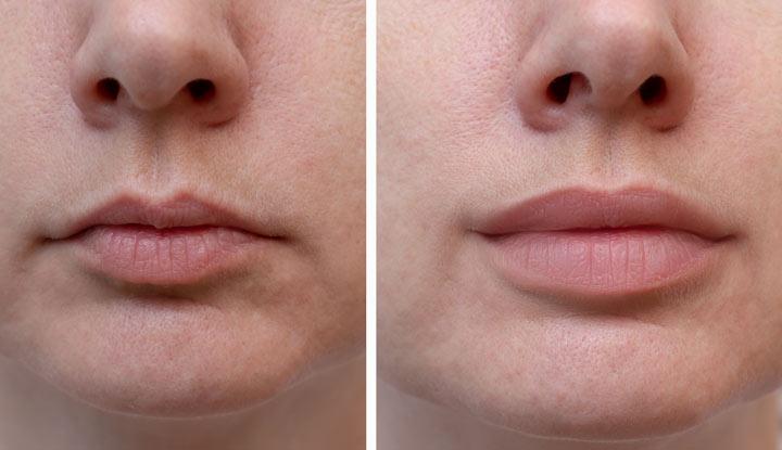 A before-and-after photo of a womans lips after lip augmentation.