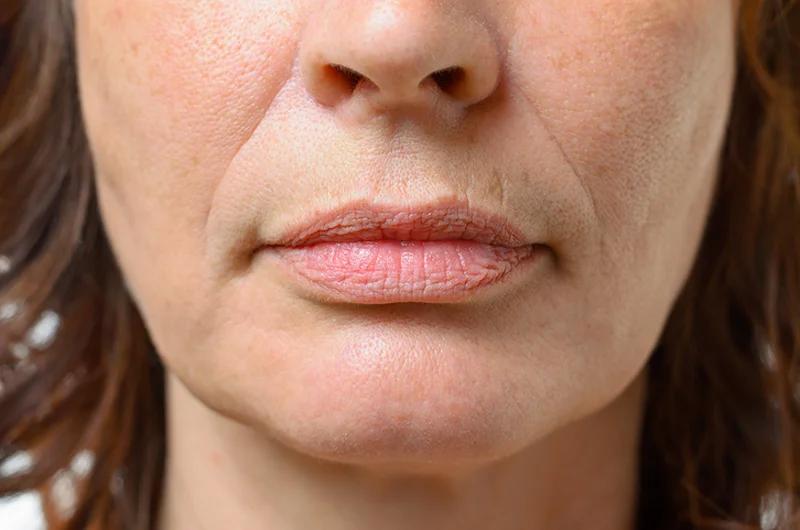 A close-up of a womans face showing dry, chapped lips.
