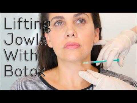 A woman receives a Botox injection in her jawline.