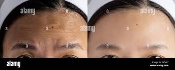 The image is a before and after photo of a womans forehead, showing the results of wrinkle treatment.