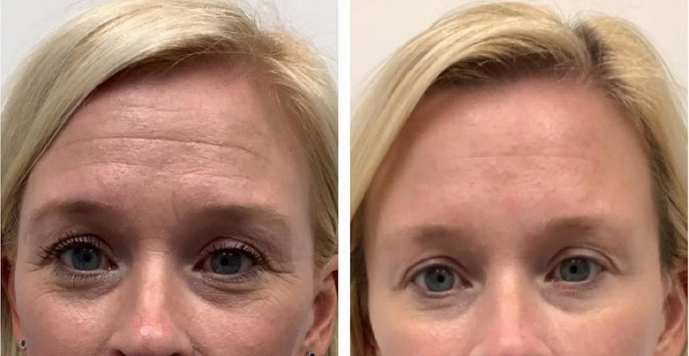 A woman with blond hair and blue eyes before and after a forehead lift.