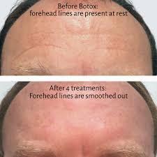 A comparison of a persons forehead before and after receiving four Botox treatments.