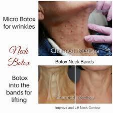 Before-and-after photos show the reduction of wrinkles on the neck after treatment with Botox.
