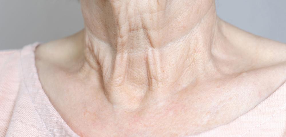 The image shows a womans neck with deep wrinkles.