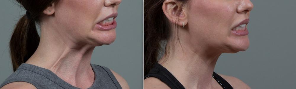 A womans neck before and after treatment with Kybella, a medication used to reduce fat under the chin.