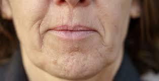 A close-up of a womans mouth and chin, showing wrinkles and signs of aging.