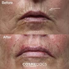 The image shows a before and after comparison of a womans lips after wrinkle reduction treatment.