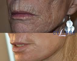 A comparison of a womans face before and after laser resurfacing treatment.