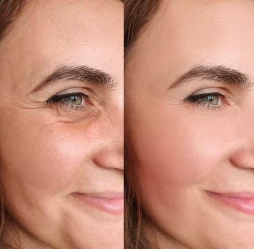 A split image of a womans face, showing the effects of botox on the left side of her face.