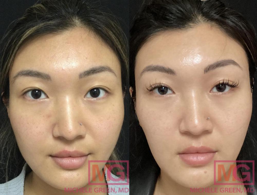 The image shows a before-and-after comparison of a woman who underwent cosmetic eyelid surgery.
