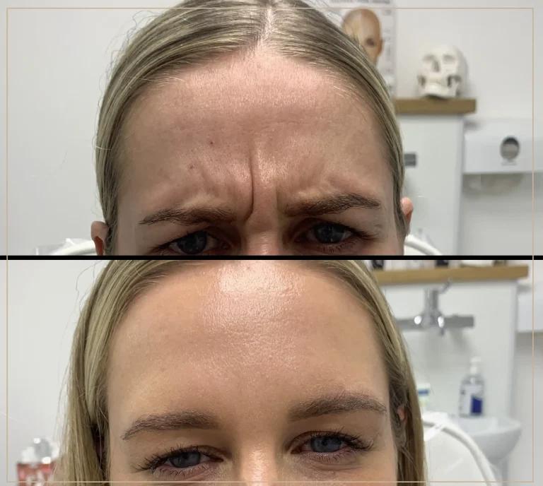 A before and after photo of a woman who had frown lines treated with Botox.