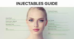 A diagram of a womans face with the different areas that can be treated with injectables labeled.