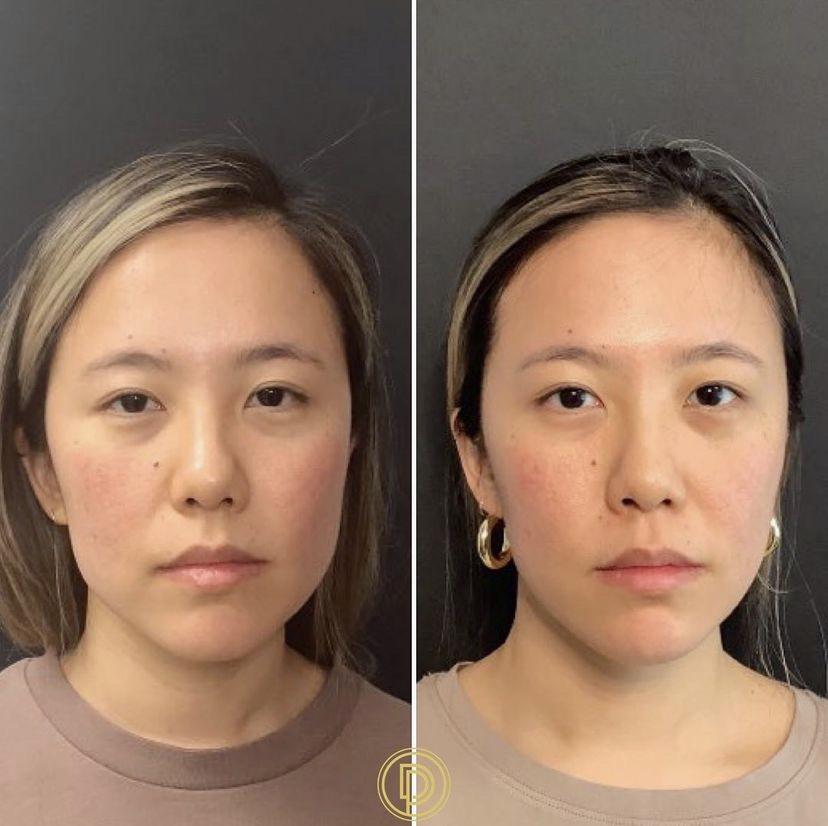 Is Botox for TMJ Covered by Insurance
