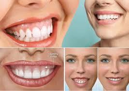 A before-and-after comparison of a womans smile after getting her teeth whitened.