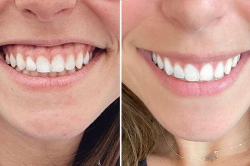 A womans smile before and after using an at-home teeth whitening kit.
