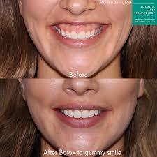 The image shows a before and after comparison of a woman who underwent Botox treatment for her gummy smile.
