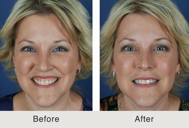 The image shows a woman with blond hair smiling, with a before and after comparison of a cosmetic procedure.