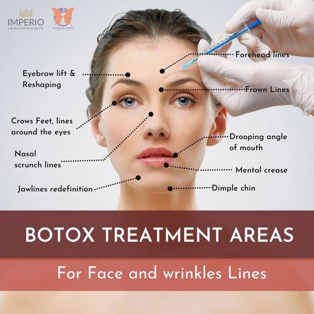 A diagram of a womans face with various points labeled for botox treatment areas.