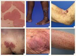 Various skin conditions including eczema, psoriasis, and cellulitis.