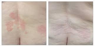 Before and after image of a persons back with atopic dermatitis treated with Eucrisa.
