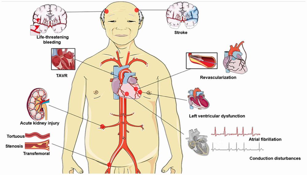 A diagram of the body showing the potential complications of transcatheter aortic valve replacement (TAVR).