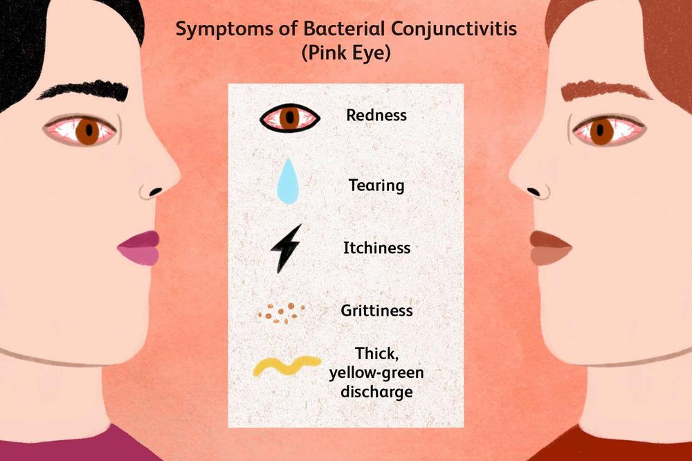 An illustration showing a person with red, watery eyes, and a list of symptoms of bacterial conjunctivitis.