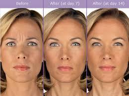 The image shows a womans face before and after receiving Botox injections, with the results after 7 days and after 14 days.