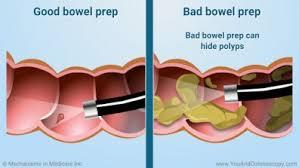 A comparison of a good and bad bowel prep, the bad prep has a lot of stool and the good prep is clean.