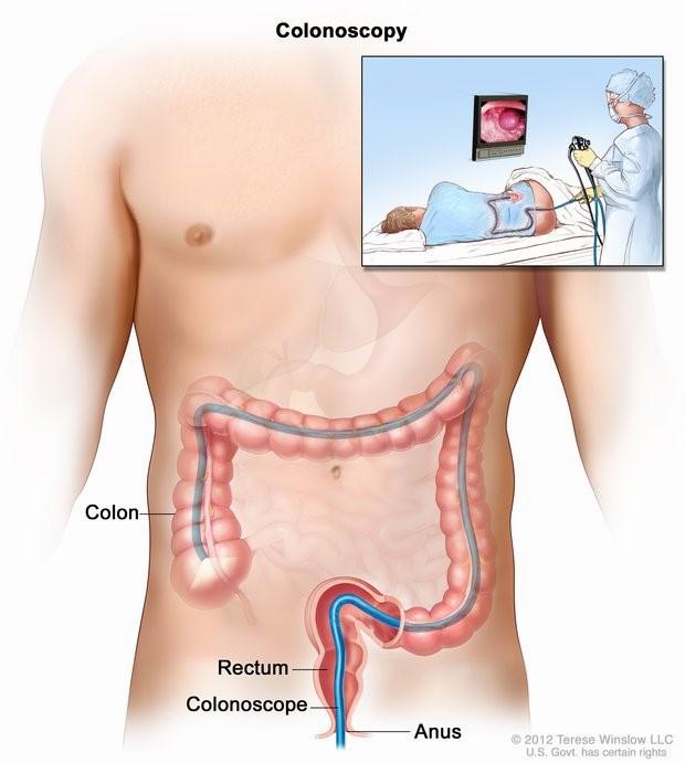 A colonoscopy is a procedure where a thin, flexible tube with a camera on the end is inserted into the colon to look for abnormalities.