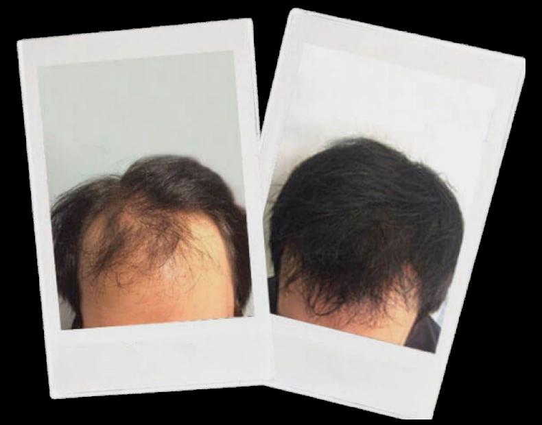 A before and after comparison of a hair transplant procedure.