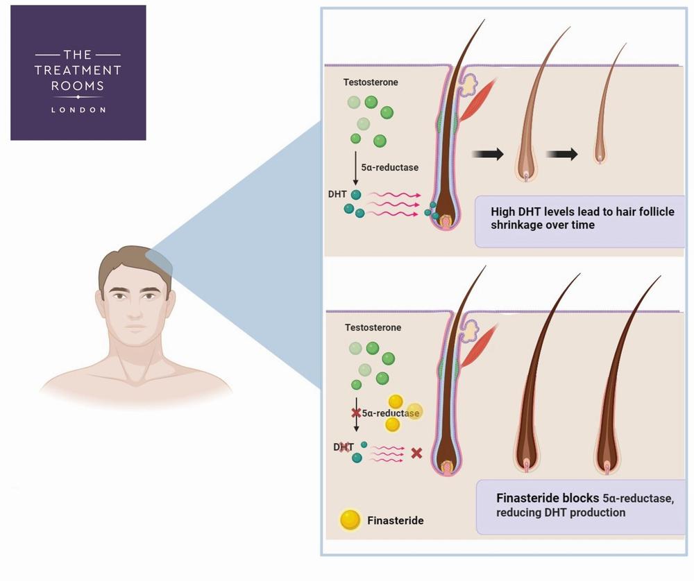 A diagram showing how finasteride works to reduce DHT production and prevent hair loss.